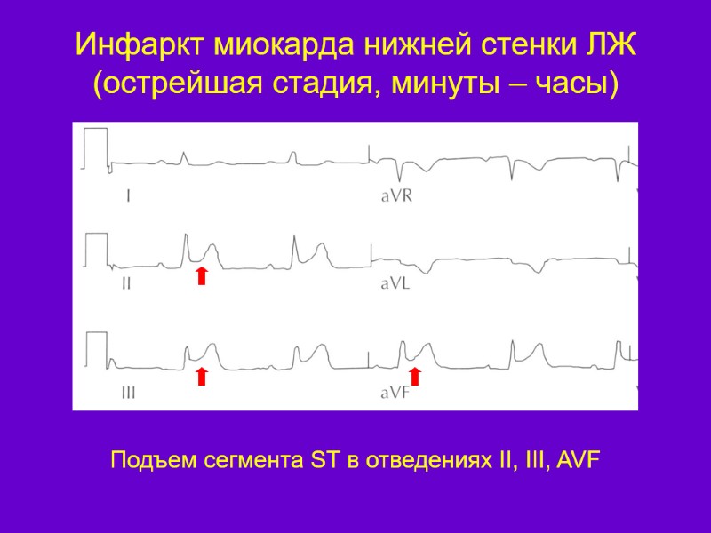 Инфаркт миокарда нижней стенки ЛЖ (острейшая стадия, минуты – часы)  Подъем сегмента ST